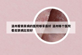 温州看银屑病的医院哪家最好 温州哪个医院看皮肤病比较好