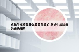 点状牛皮癣是什么原因引起的 点状牛皮肤癣的症状图片
