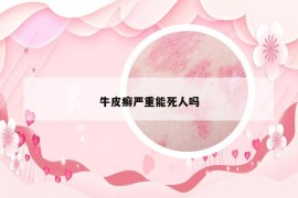 牛皮癣严重能死人吗