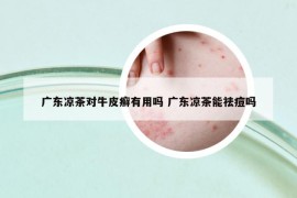 广东凉茶对牛皮癣有用吗 广东凉茶能祛痘吗