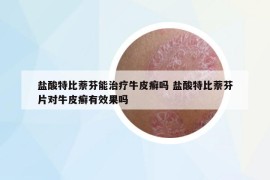 盐酸特比萘芬能治疗牛皮癣吗 盐酸特比萘芬片对牛皮癣有效果吗