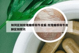 如何区别玫瑰糠疹和牛皮癣 玫瑰糠疹和牛皮鲜区别照片