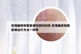 玫瑰糠疹和银屑病可同时的吗 玫瑰糠疹和银屑病治疗方法一样吗