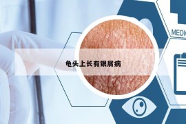 龟头上长有银屑病