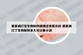银屑病打完生物制剂病情还有新长的 银屑病打了生物制剂多久可以要小孩