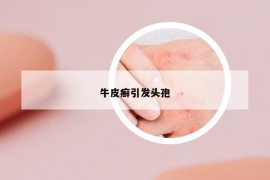 牛皮癣引发头孢