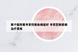 那个医院看寻常性银血病追好 寻常型银屑病治疗费用
