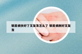 银屑病快好了又复发怎么了 银屑病刚好又复发