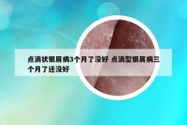点滴状银屑病3个月了没好 点滴型银屑病三个月了还没好