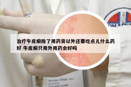 治疗牛皮癣除了用药膏以外还要吃点儿什么药好 牛皮癣只用外用药会好吗