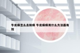 牛皮癣怎么去除痒 牛皮癣痒用什么方法最有效
