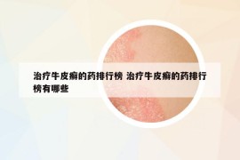 治疗牛皮癣的药排行榜 治疗牛皮癣的药排行榜有哪些