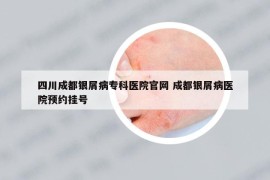 四川成都银屑病专科医院官网 成都银屑病医院预约挂号