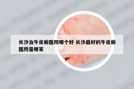 长沙治牛皮癣医院哪个好 长沙最好的牛皮癣医院是哪家
