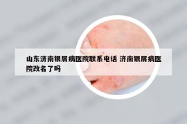 山东济南银屑病医院联系电话 济南银屑病医院改名了吗