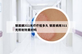 银屑病311光疗疗程多久 银屑病用311光照射效果好吗