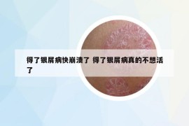 得了银屑病快崩溃了 得了银屑病真的不想活了