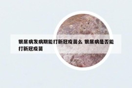 银屑病发病期能打新冠疫苗么 银屑病是否能打新冠疫苗