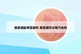 银屑病能喝雪碧吗 银屑病可以喝汽水吗