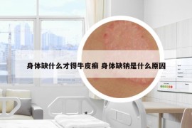 身体缺什么才得牛皮癣 身体缺钠是什么原因