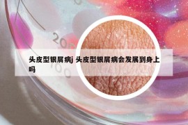 头皮型银屑病j 头皮型银屑病会发展到身上吗