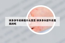 拼多多牛皮癣是什么意思 拼多多头层牛皮是真的吗