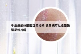 牛皮癣能吃醋酸泼尼松吗 银屑病可以吃醋酸泼尼松片吗
