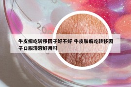 牛皮癣吃转移因子好不好 牛皮肤癣吃转移因子口服溶液好用吗