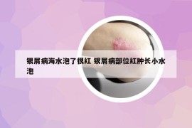 银屑病海水泡了很红 银屑病部位红肿长小水泡
