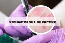 有银屑病能吃乌鸡白凤丸 银屑病能吃乌贼吗