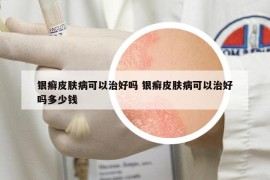 银癣皮肤病可以治好吗 银癣皮肤病可以治好吗多少钱