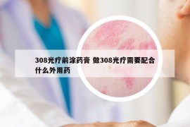 308光疗前涂药膏 做308光疗需要配合什么外用药