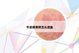 牛皮癣黑斑怎么遮盖