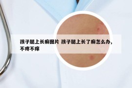 孩子腿上长癣图片 孩子腿上长了癣怎么办,不疼不痒