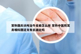常熟魏氏诊所治牛皮癣怎么样 常熟中医院耳鼻喉科魏廷文有去湖北吗