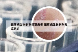 银屑病生物制剂招募患者 银屑病生物制剂专家共识