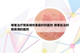 哪里治疗银屑病效果最好的医院 哪里能治好银屑病的医院