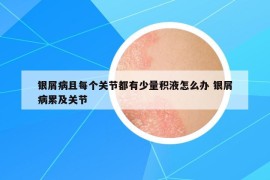 银屑病且每个关节都有少量积液怎么办 银屑病累及关节