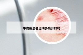 牛皮癣患者运动多出汗好吗