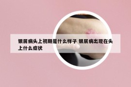 银屑病头上初期是什么样子 银屑病出现在头上什么症状