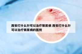 西安打什么针可以治疗银屑病 西安打什么针可以治疗银屑病的医院