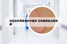 沈阳治疗银屑病的中医院 沈阳哪里能治银屑病