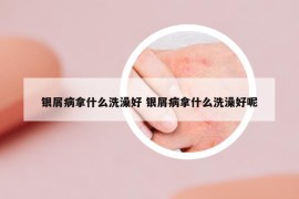 银屑病拿什么洗澡好 银屑病拿什么洗澡好呢