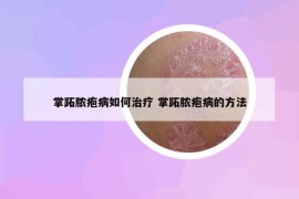 掌跖脓疱病如何治疗 掌跖脓疱病的方法