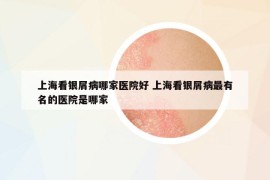 上海看银屑病哪家医院好 上海看银屑病最有名的医院是哪家