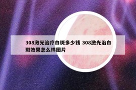308激光治疗白斑多少钱 308激光治白斑效果怎么样图片