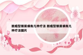 脓疱型银屑病有几种疗法 脓疱型银屑病有几种疗法图片