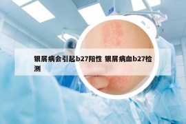 银屑病会引起b27阳性 银屑病血b27检测