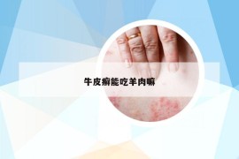 牛皮癣能吃羊肉嘛