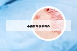 小孩有牛皮癣咋办